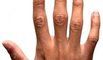 El dedo índice y anular diferente puede indicar mayor tendencia a ser lesbianas