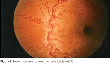 Retinopatía falcémica