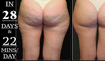 El uso correcto del vinagre de sidra de manzana para eliminar la celulitis en la noche â?¦