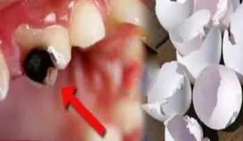 Usted no sabe lo que las cáscaras de huevo puede hacer por sus dientes. Puede regenerar sus dientes tratar y eliminar las caries