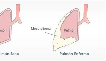 Cura para el mesotelioma cáncer de pulmón