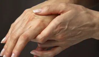 Detectar la Artritis Reumatoide a tiempo es la clave