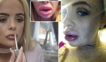 Dios mío: Mira como quedó esta mujer luego de un tratamiento de relleno de labios