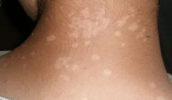  Métodos efectivos de quitar los hongos de la piel