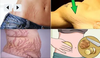 6 remedios naturales para eliminar las estrías rápido del cuerpo