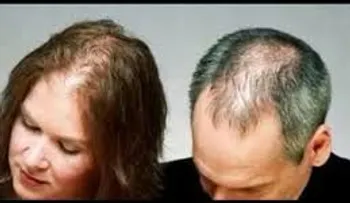 Descubra las razones que producen la calvicie en hombres y mujeres: 5 preguntas comunes
