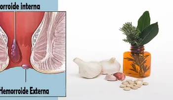Acaba con las hemorroides internas y externas si aplicas uno de estos 6 remedios