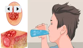 Jefe jubilado de una farmacia dijo:"El mundo tiene que saber, que el agua alcalina mata el cáncer". Aquí esta la receta!