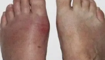 3 días para eliminar el ácido úrico y los síntomas de gota de tu cuerpo 