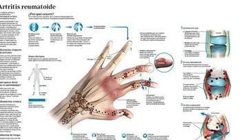 Persistencia en el tratamiento de artritis reumatoide, marca la diferencia en el cuidado de los pacientes