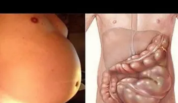 Tenía la panza grandísima por un estreñimiento por la comida chatarra, tomé vinagre con miel y en 7 días el problema desapareció 