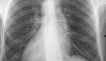 ¿ Qué es la cardiopatía del corazón al revés?