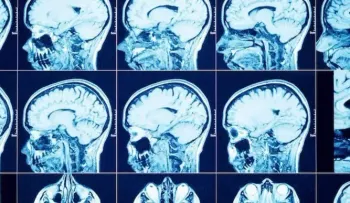 Crean un tumor cerebral activo en 3D que ayudará a investigar tratamientos