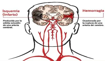 Accidente cerebrovascular tercera causa mortalidad en Venezuela