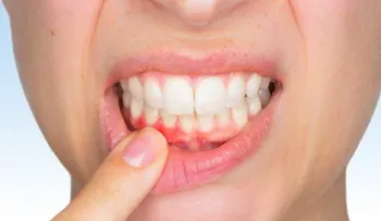 Signos de que tienes un absceso dental y cómo tratarlo naturalmente