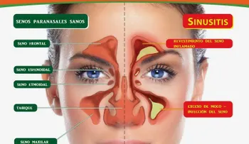 La fiebre es el signo más alarmante de la sinusitis maxilar: Tips para curarla 