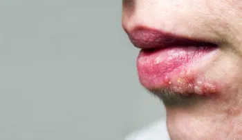 Herpes genital sus síntomas, causas y tratamientos naturales