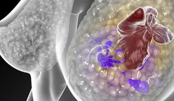 Explican cómo la obesidad promueve el cáncer de mama