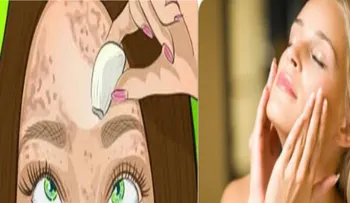 Imperdible remedio que borra las manchas como una goma en mujeres y hombres: Te deja una piel perfecta