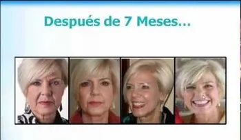 Como rejuvenecer hasta 15 años en 90 días sin botox ni cirugía