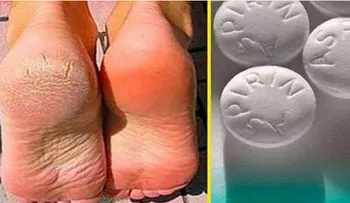 Nunca fue tan fácil eliminar las varices, los callos y los pies agrietados 