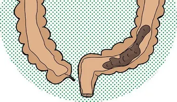 Eliminar exceso de heces en el intestino con vinagre y miel