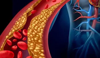 Esta es la forma natural más efectiva y rápida de bajar triglicéridos