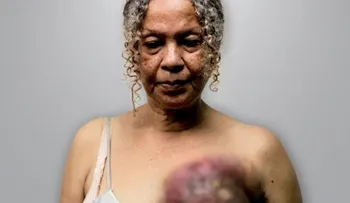 Venezuela está conmovida con el cáncer de seno de Elizabeth Salazar