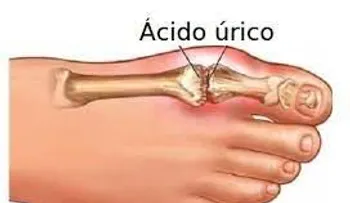  Elimina el ácido úrico con solo 2 cebollas: Cómo hacerlo; DIETA 