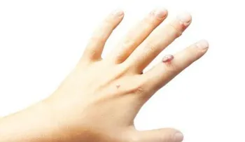 ¡Todos las tenemos pero nadie sabe quitarlas fácilmente! Estos quita verrugas hacen maravillas