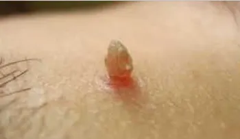 Remedio para quitar una verruga de la piel para siempre (VIDEO)