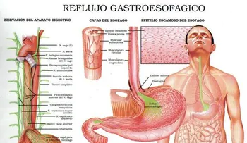 Las causas y síntomas del reflujo gástrico