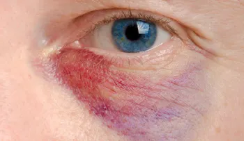 Los mejores remedios para mejorar un ojo morado