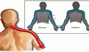 Cervicobraquialgia: El dolor que va del cuello hasta el brazo...Entérate de más!!