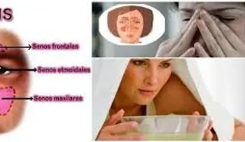 La sinusitis; 3 remedios caseros