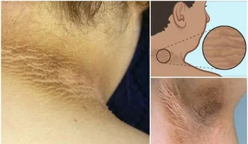 Con este remedio, en 5 días blanquearás tus axilas, rodillas y cuello