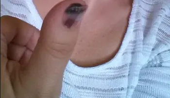 Esta mujer quiere advertir sobre la importancia de revisarte la piel después de ser diagnosticada de cáncer