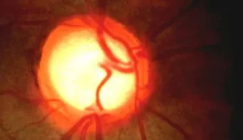  Grupo Hospiten realiza campaña de prevención por Día Mundial del Glaucoma