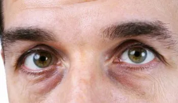 4 soluciones naturales para acabar con las ojeras