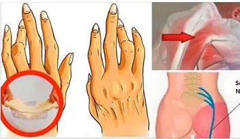 Truco super simple para combatir la artritis, dolor de espalda y ciática sin tomar píldoras