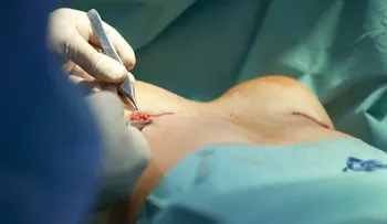 Liposucción: mitos y verdades