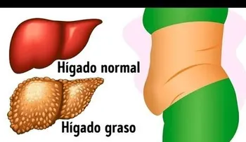 Estas 10 señales te indican que tu hígado está lleno de toxinas