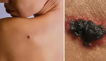 Descubren un mecanismo que causa la metástasis del melanoma y cómo frenarlo