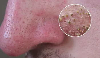 ¡Deshazte de las espinillas de la cara en un santiamén!