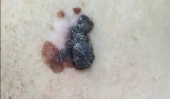 Proteja su piel y evite la aparición del melanoma