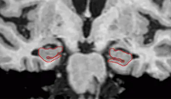 Ausencia de encogimiento cerebral puede predecir quién desarrolla demencia