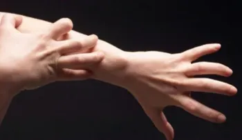 ¡A cuidarse! Aumentan casos de escabiosis en Venezuela