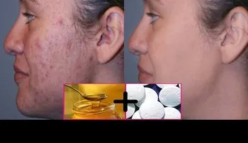 Lucirás como una princesa o un príncipe: peeling fácial con aspirina y miel durante 10 minutos. Luego mírate al espejo