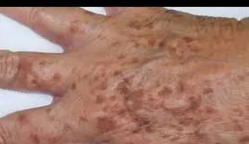 Un remedio que funciona para eliminar las manchas de las manos, por edad o por el sol
