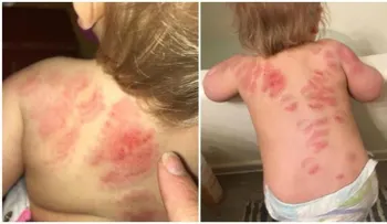¿La guardería sería un lugar seguro?; descubrió que su bebé fue mordido más de 25 veces 